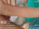 Reporte de brotes en piel de usuarios de los HCB Tiempo Completo de Bienestar del Barrio Los Laureles que presentaron erupciones y brotes en piel